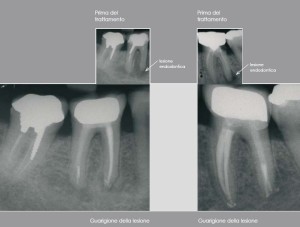 endodonzia